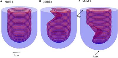 Numerical Simulation Study on the Mechanism of Formation of Apical Aneurysm in Hypertrophic Cardiomyopathy With Midventricular Obstruction